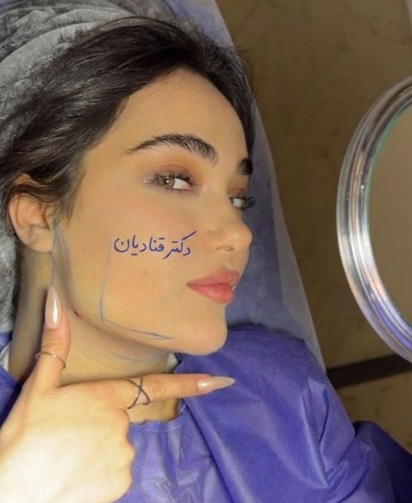 لیپوساکشن غبغب