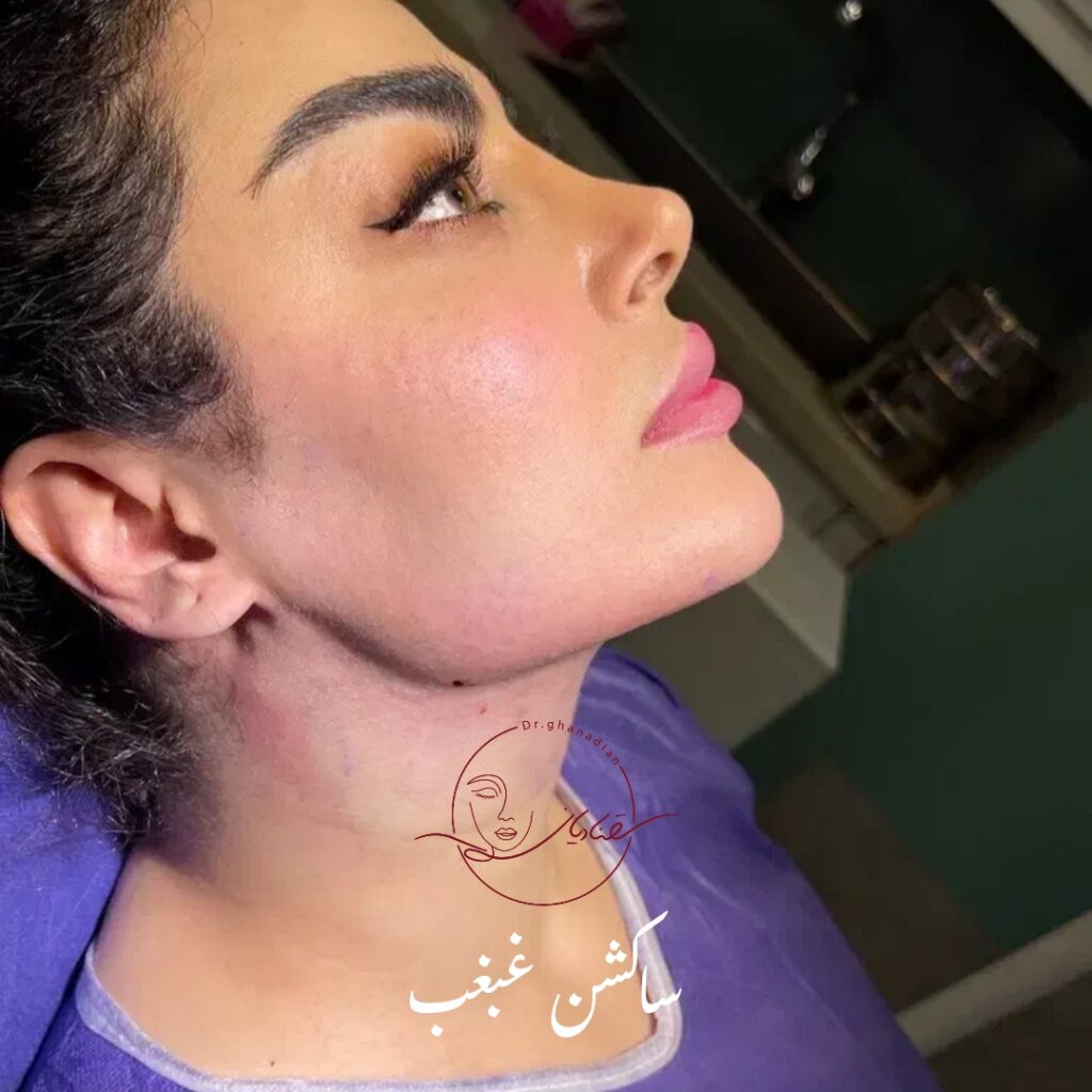 لیپوساکشن غبغب در اصفهان