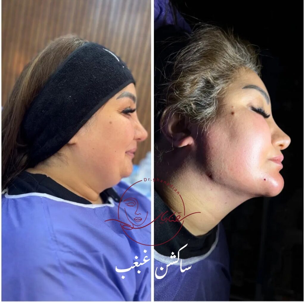 لیپوساکشن غبغب بعد از درمان